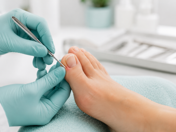 Bord d'ongles sensible Bord d'ongles sensible